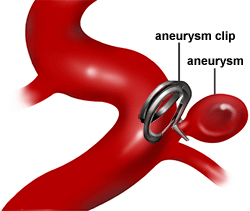 L.V. Aneurysms Operation.png